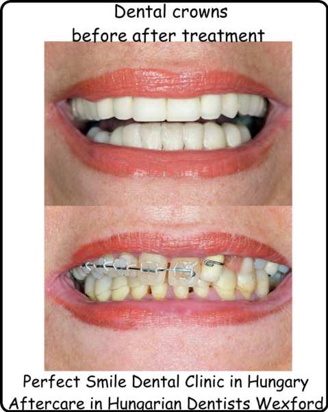 Dental crowns before after treatment image 