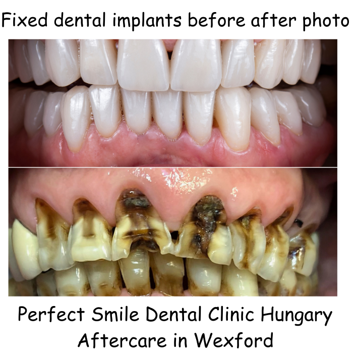 Fixed dental implants before after photo image 