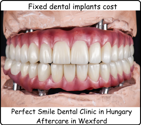 Fixed dental implants cost image 