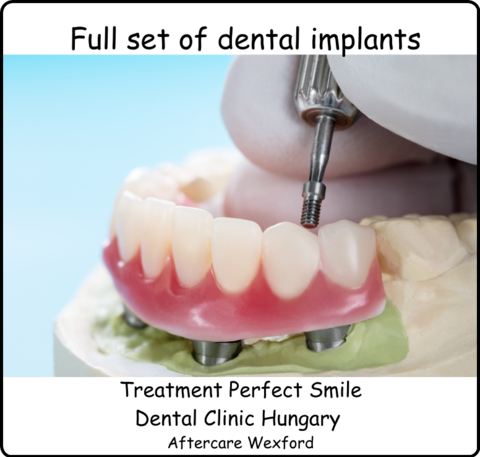 Full set of dental implants image 1