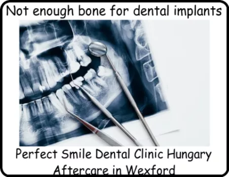 Not enough bone for dental implants image 