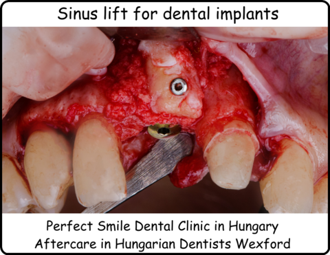 Sinus lift for dental implants image