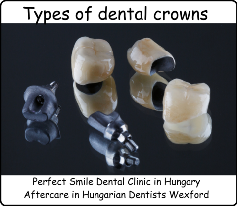 Types of dental crowns image