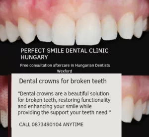 Crowns for broken teeth image