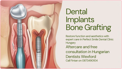 Dental implants bone grafting image 