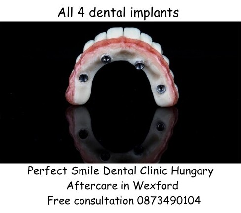 All 4 dental implants image