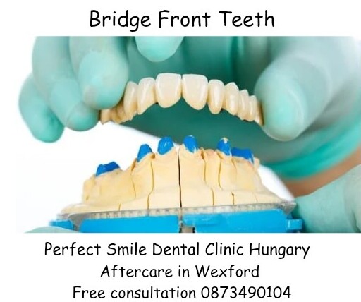 Bridge front teeth image 