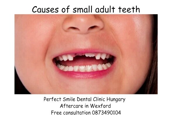 Causes on small teeth adults image