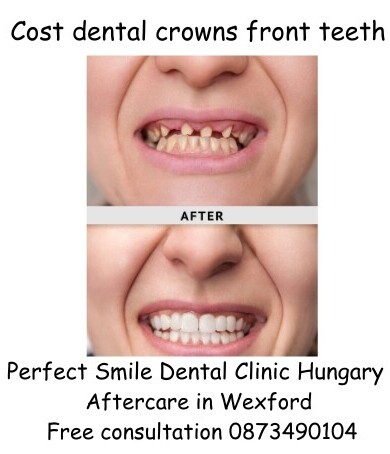 Cost dental crowns front teeth image