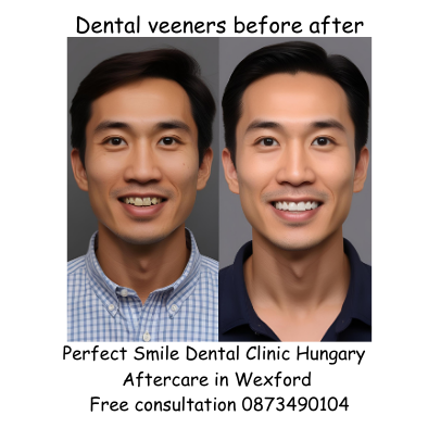 Dental veeners before after image