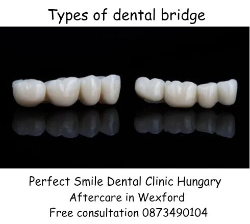 Types of dental bridge image