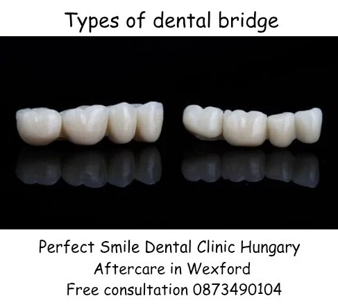 Types of dental bridge image