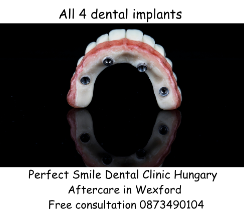 All 4 dental implants image