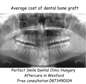 Average cost of dental bone graft image