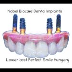 Nobel Biocare dental implants image