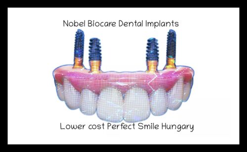 Nobel Biocare dental implants image 