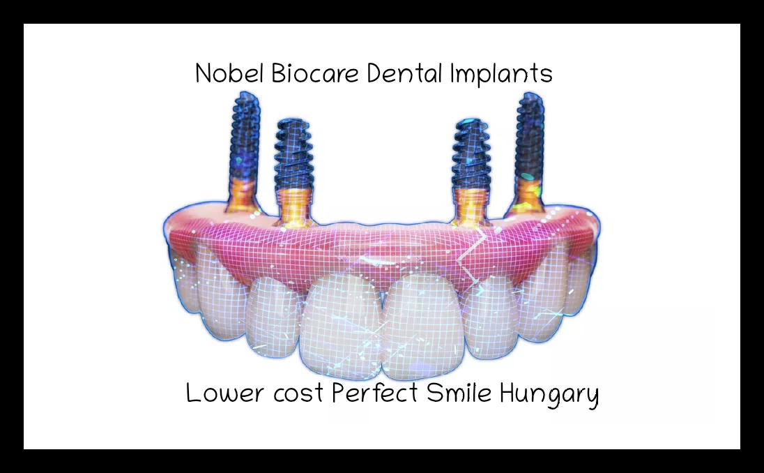 Nobel Biocare dental implants image