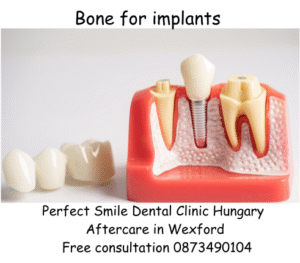 Bone for implants image
