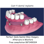 Cost 4 dental implants image