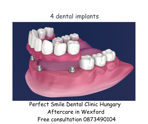 4 dental implants image