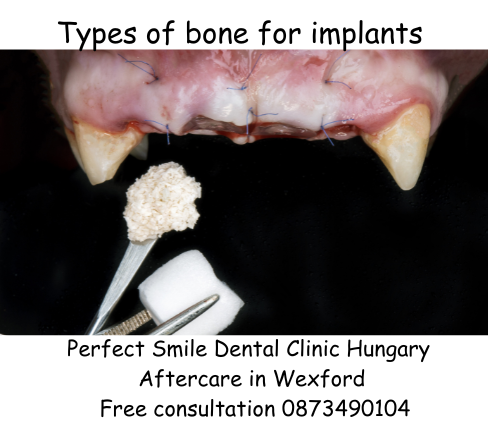 Types of bone for implants image