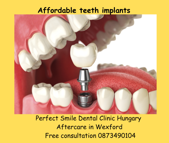 Affordable teeth implants image