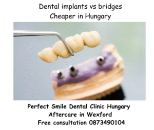 Dental implants vs bridges pros cons treatment procedure and cost image