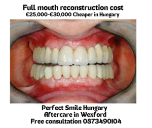 Full mouth reconstruction cost image