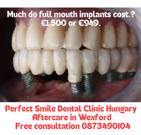 Much do full mouth implants cost image
