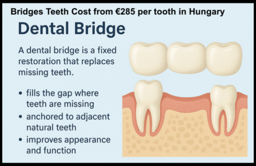 Bridges teeth cost