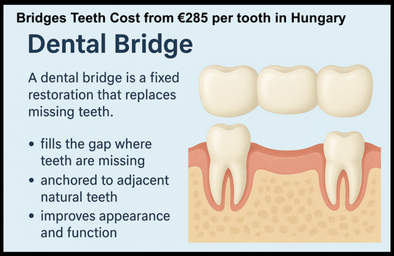 Dental bridge cost in Hungary image