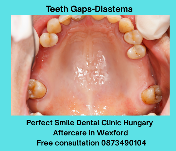 Teeth gaps diastema image