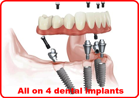 All on 4 dental implants image