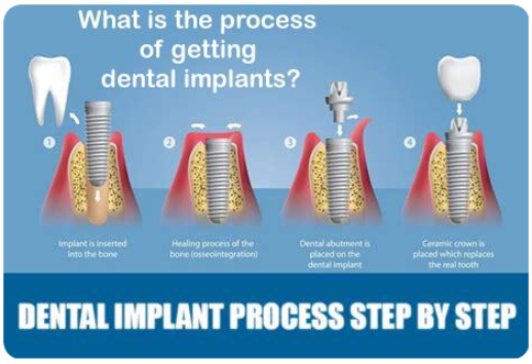 What is the process of getting full mouth implants image