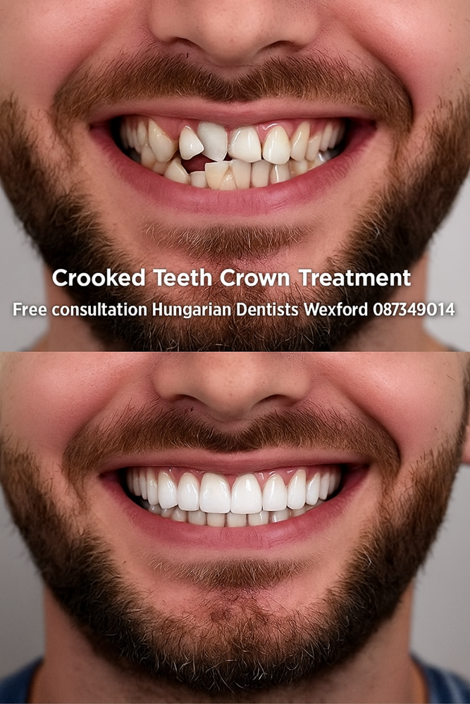 Crooked teeth crown treatment image