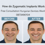 How do Zygomatic implants work image