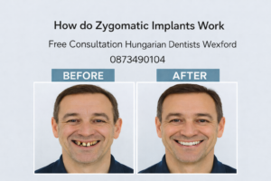 How do Zygomatic implants work image