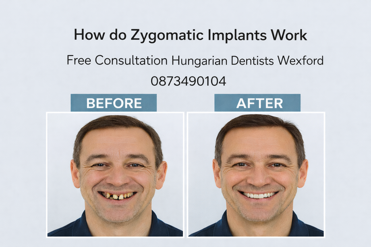 How Do Zygomatic Implants Work