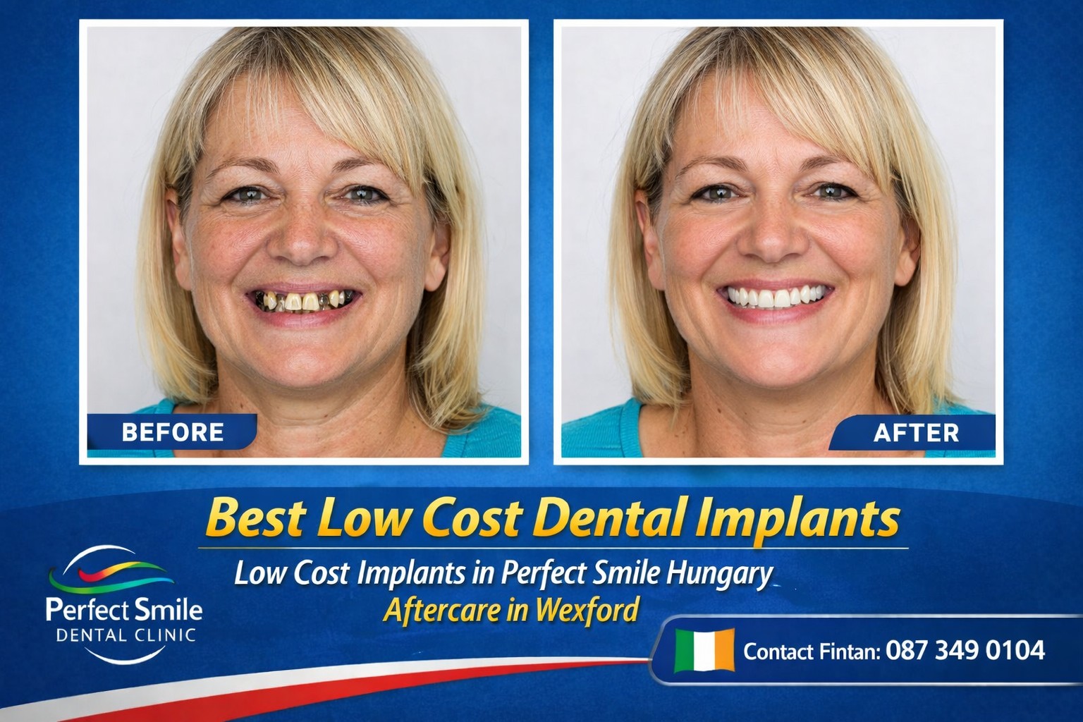 Best low cost dental implants image