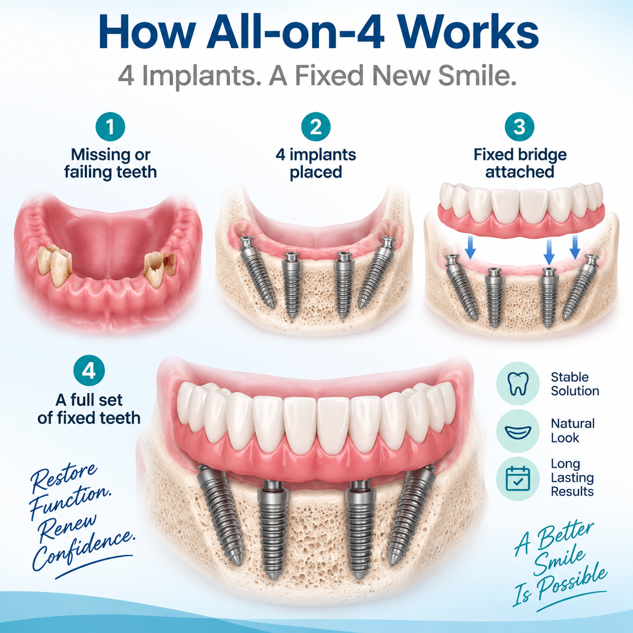 How All-on-4 dental implants work with four implants supporting fixed teeth