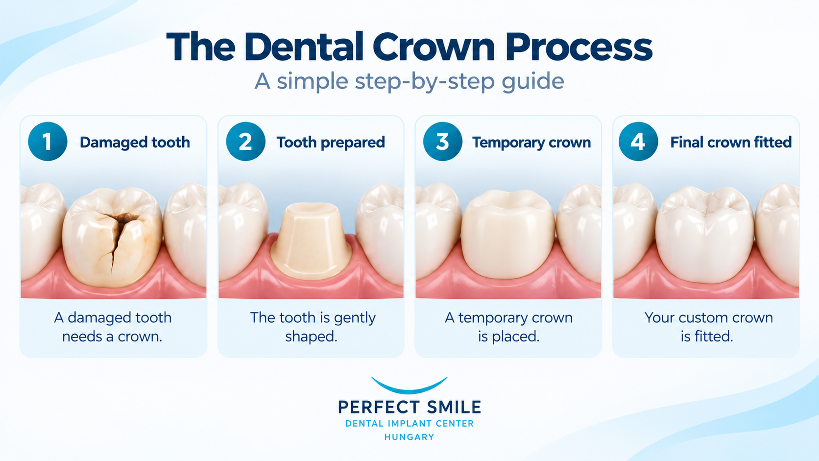 Dental crown process step by step