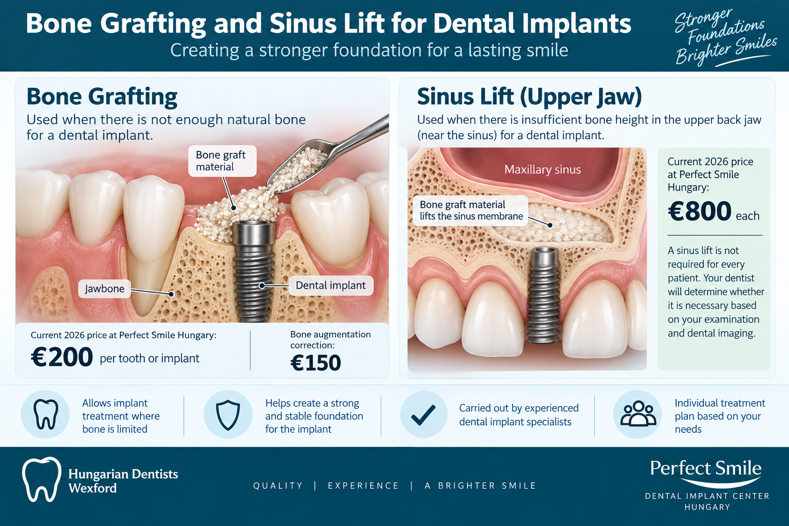 Bone grafting and sinus lift for dental implants showing 2026 prices at Perfect Smile Hungary
